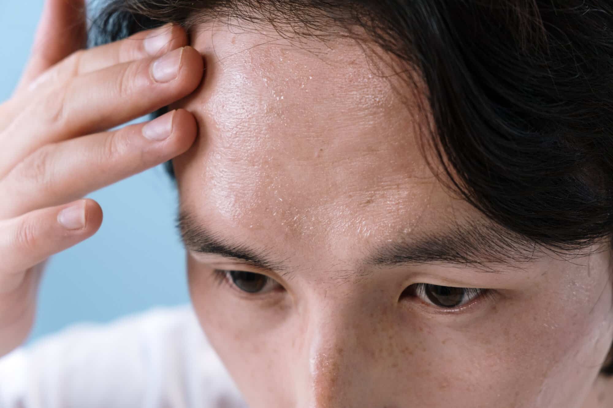 Man touching his sweaty forehead suspecting he has fever, one of the chagas disease symptoms.